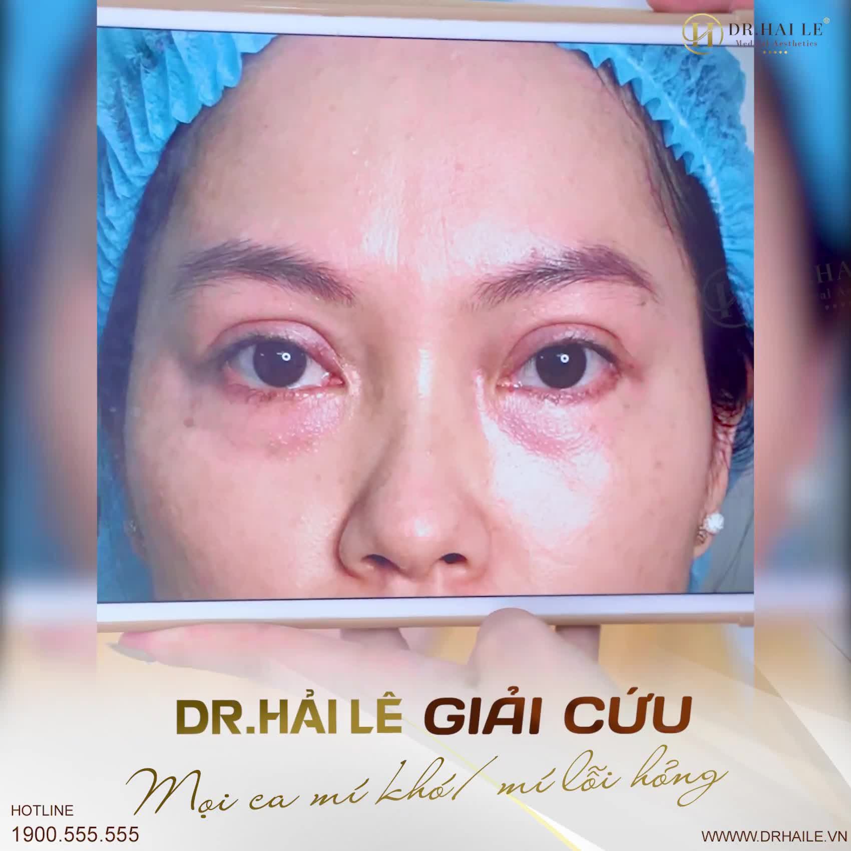 Cho tất cả khách hàng khu vực phía Nam Dr.Hải Lê cơ sở HCM tiếp nhận chỉnh hình mọi ca mí lỗi hỏng từ nhẹ đến nặng!